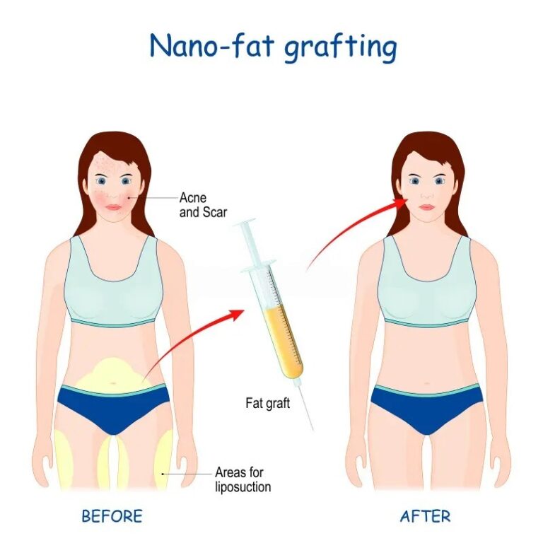 fat transfer