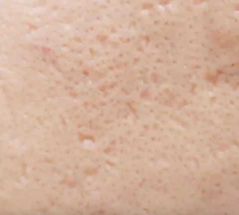 ice pick scar subcision