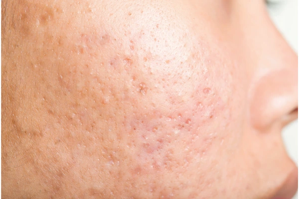 mix scars subcision