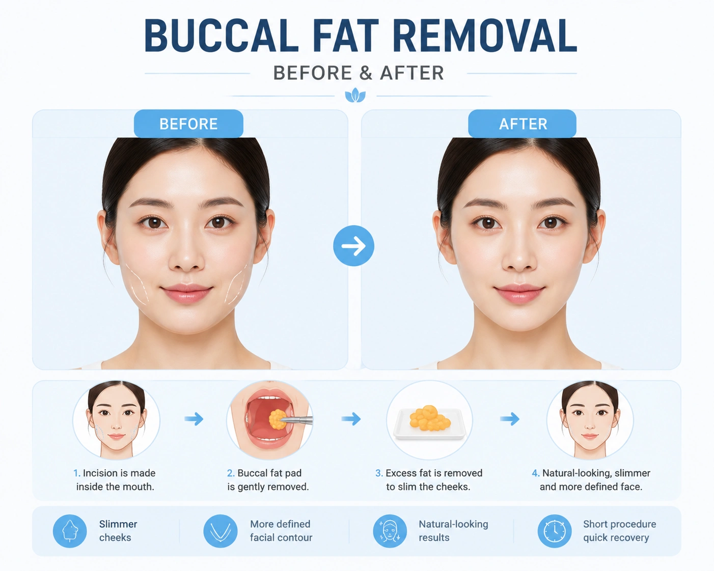 Buccal Fat Removal Before and After: Face Shape Changes by Age 1 Buccal Fat Removal Before and After: Face Shape Changes by Age