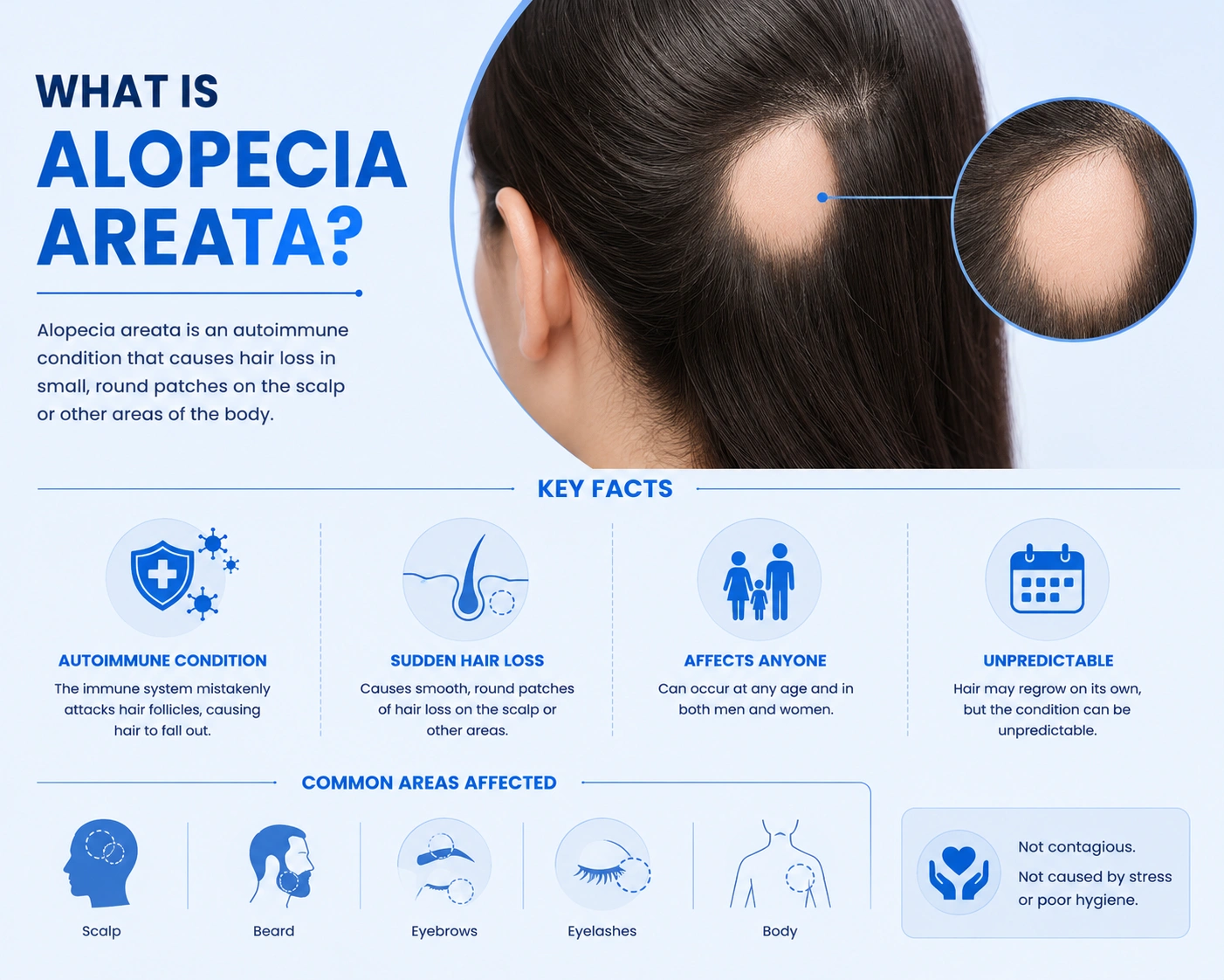 What is Alopecia Areata? Patchy Hair Loss and Recovery Options 1 Alopecia Areata: Causes, Symptoms & Best Hair Regrowth Treatments
