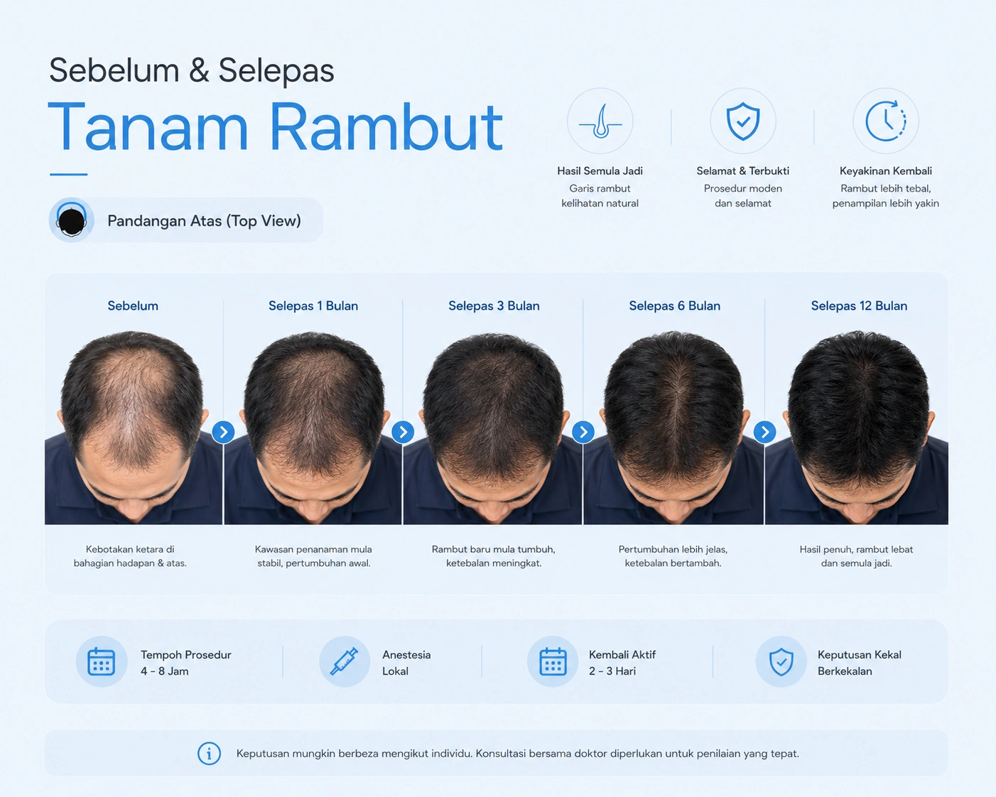 Tanam Rambut: Patut Buat Ke Tak? Harga, Prosedur, Sakit atau tak & Risiko Jujur Dari Doktor 2 sebelum dan selepas tanam rambut di GLOJAS
